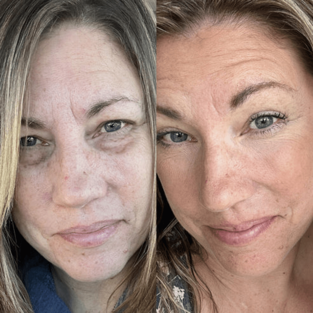 RejuvEyes™ Under-Eye Red Light Therapy