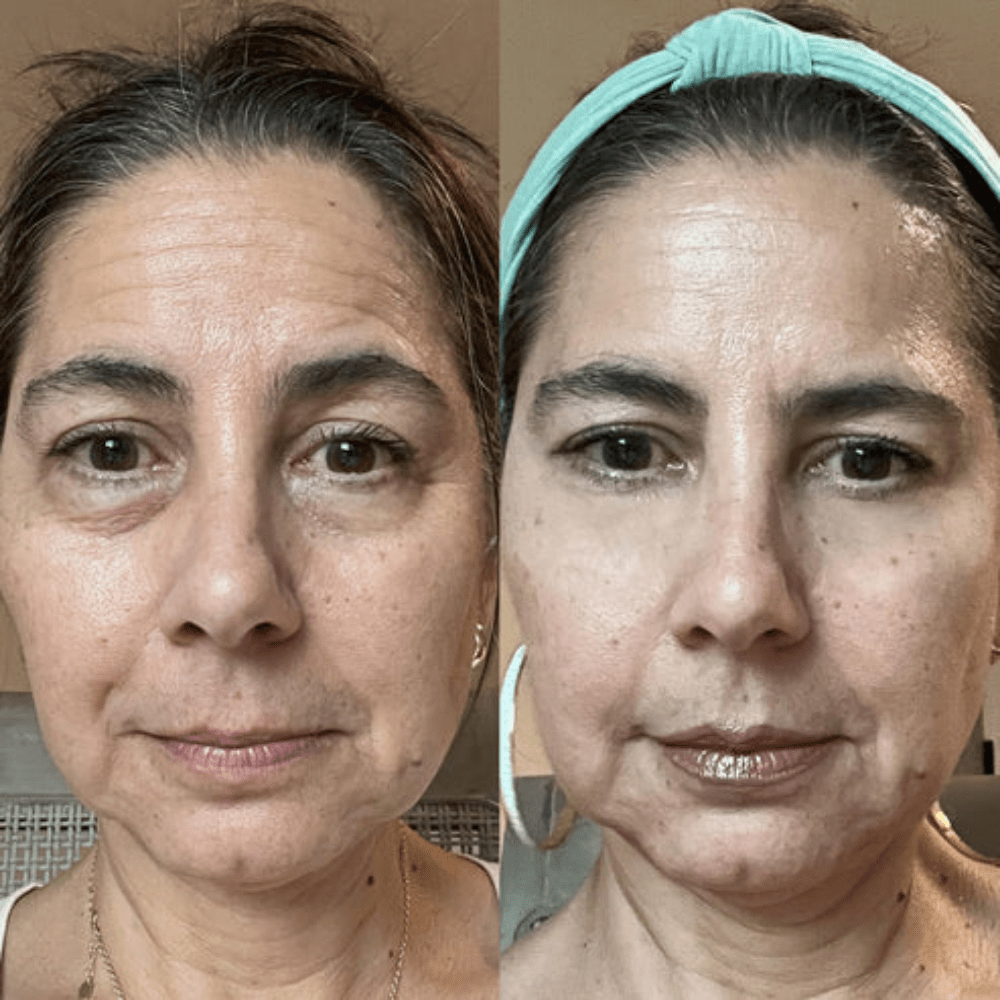 RejuvEyes™ Under-Eye Red Light Therapy