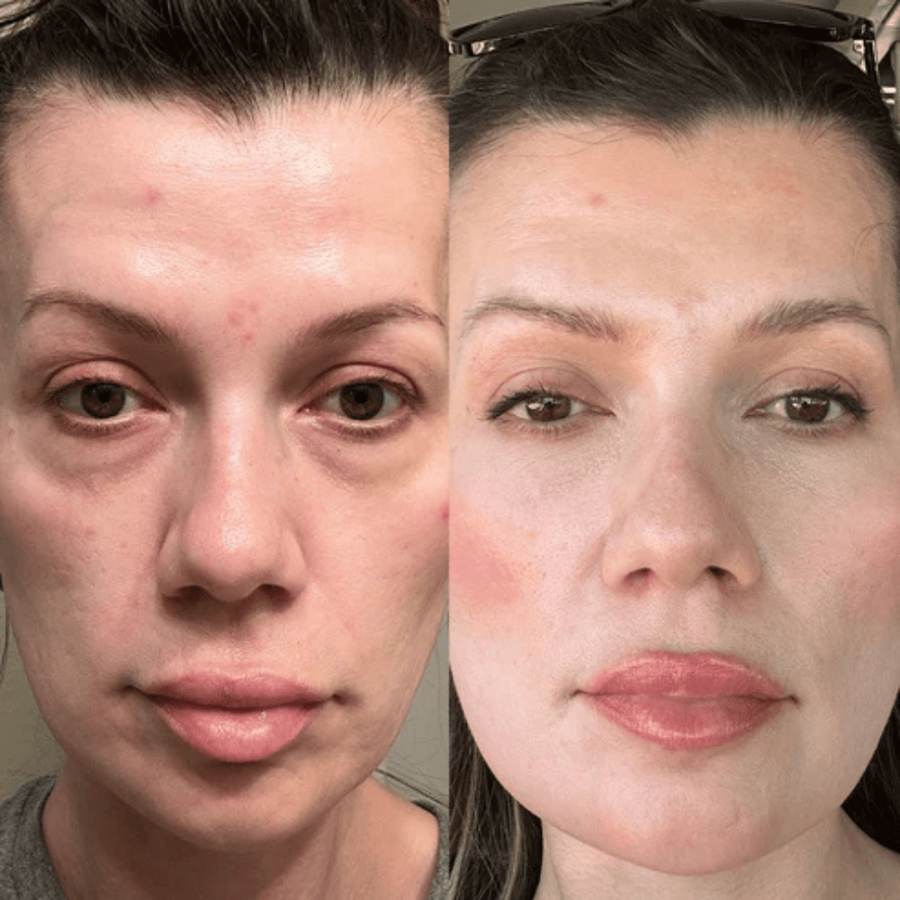 RejuvEyes™ Under-Eye Red Light Therapy